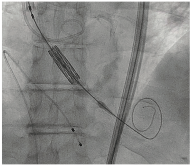 Embolization of Prosthetic Valve Into the Ascending Aorta During